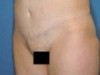 abdominoplastie